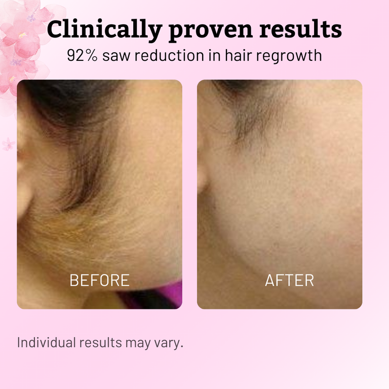 Cyperus Rotundus Oil for Hair Reduction