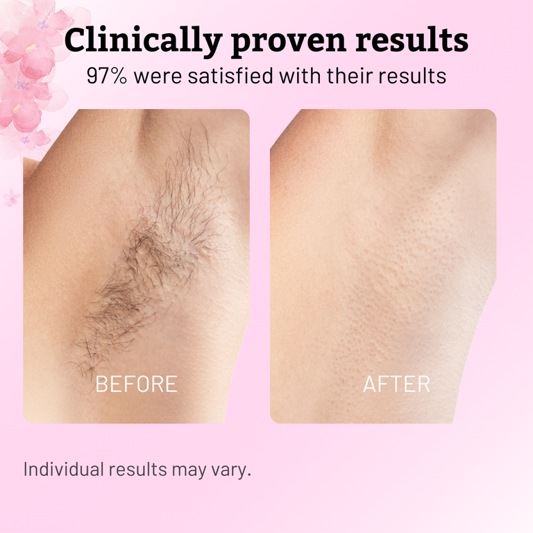Cyperus Rotundus Oil for Hair Reduction
