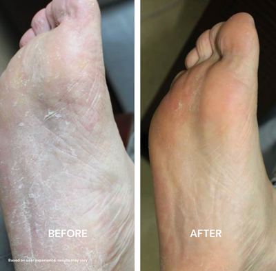 PureFoot Relief Stick