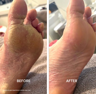 PureFoot Relief Stick